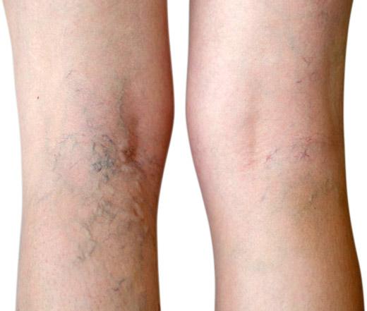 Varicose Veins Treatment Cream - MakenShop